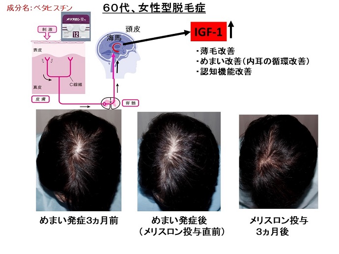 円形脱毛症　病院
